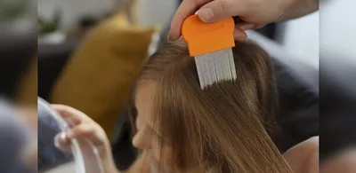Como reconhecer a pediculose infantil e evitar a reinfestação